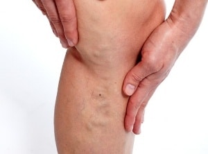 painful legs