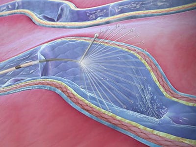 ClariVein-procedure-400x300 ClariVein-procedure-400x300