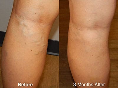 clarivein-400x300 clarivein postop