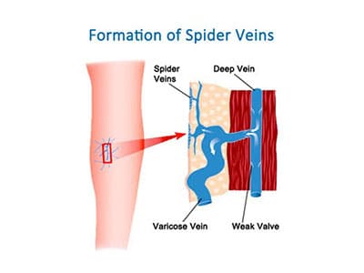 spider-veins-400x300 spider veins formation
