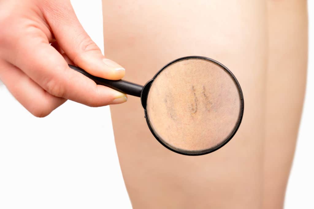 See Varicose Veins