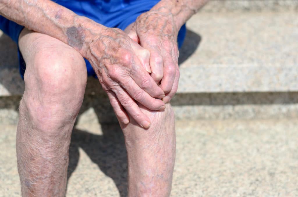 injured varicose vein